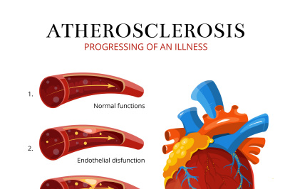 Atherosclerosis&2C; blood clot formation. Vector medical illustration