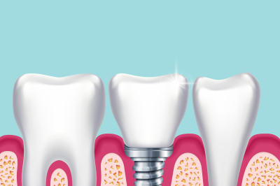 Human teeth and dental implant in jaw orthodontist medical vector illu