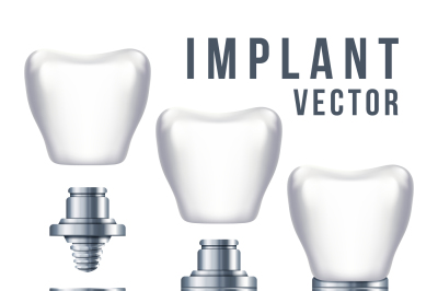 Dental tooth implant and parts vector illustration