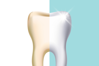 Dental veneer&2C; teeth whitening vector concept