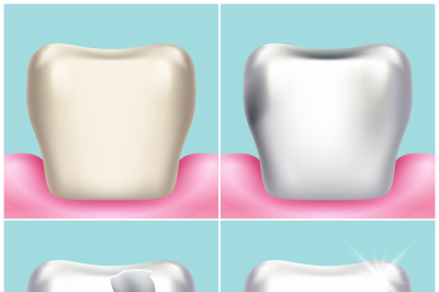 Dental problems&2C; caries&2C; plaque and gum disease&2C; healthy tooth vector 