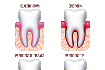 Human gum disease, gums bleeding. Tooth prevention dental, oral care v