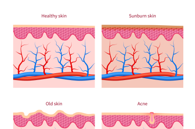 Skin types healthy, sunburn and old acne vector set