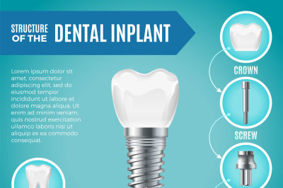 Teeth maquette. Structural elements of dental implant. Infographic for