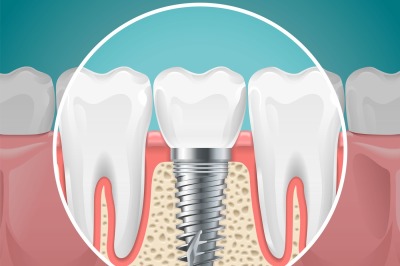 Stomatology illustrations. Dental implants and healthy teeth