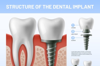 Dental teeth implant. Implantation procedure or tooth crown abutments.