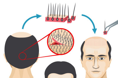 Male hair loss treatment medical vector infographic