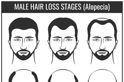Hair loss stages and types of baldness. Man hairs problem vector chart