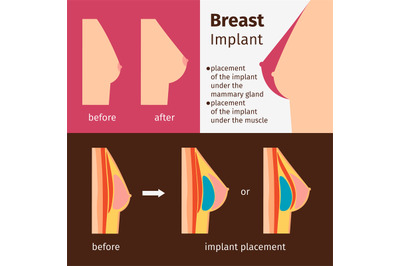 Breast implants infographics