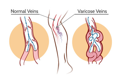 Varicose veins illustration