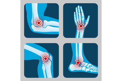 Human joints with pain rings. Arthritis and rheumatism infographic. Me