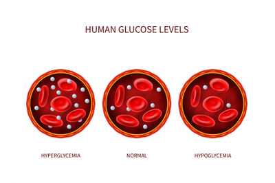 Human glucose levels hyperglycemia&2C; normal&2C; hypoglycemia. Hematology v