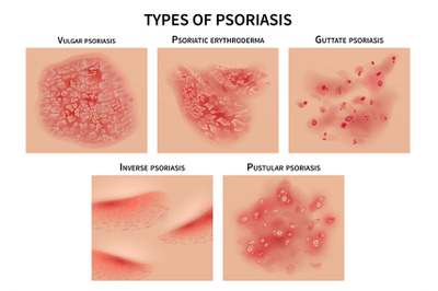 Psoriasis types. Skin hives&2C; derma diseases. Closeup medical vector il