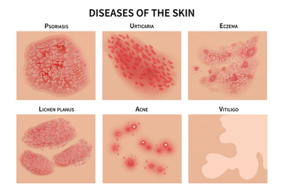 Skin diseases. Derma infection&2C; eczema and psoriasis. Dermatology vect