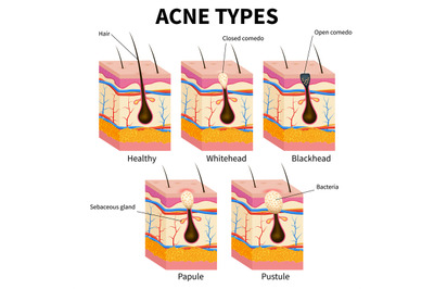 Acne types. Pimple skin diseases anatomy medical vector diagram