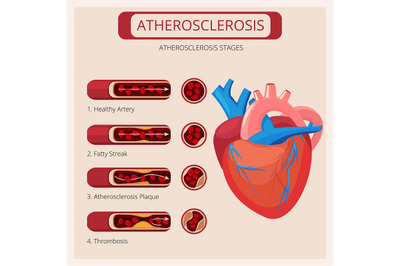 Atherosclerosis stages. Heart strokes thrombus attack blood circulator