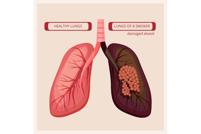 Smoker lungs. Smoke human damage lung cancer vector medical infographi