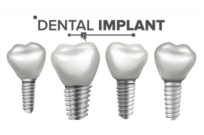 Dental Implant Set Vector. Implant Structure. Crown, Abutment, Screw. Care, Stomatology. Realistic Isolated Illustration