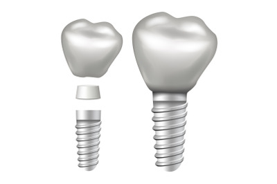 Dental Implant Vector. Implant Structure. Crown, Abutment, Screw. Realistic Isolated Illustration