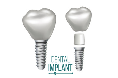 Dental Implant Vector. Medical Poster, Banner Design Element. Stomatology Dentist Advertisement. Realistic Isolated Illustration