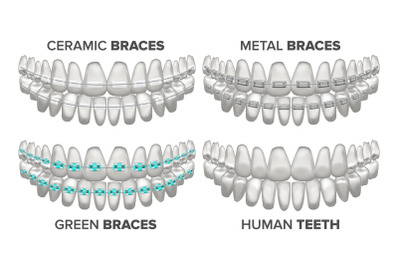 Braces Set Vector. Different Types. Human Jaw. Metal, Ceramic, Child. 3D Realistic Isolated Illustration