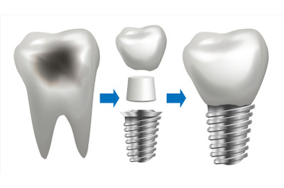 Dental Implant Vector. Tooth With Caries. Health Tooth Implant. Dental Clinic Stomatology Flyer. Realistic Isolated Illustration