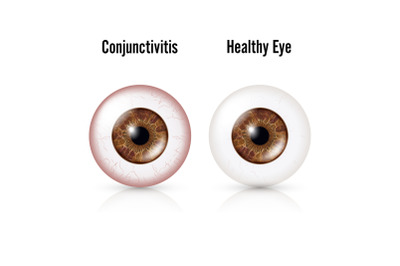 Conjunctivitis. Red Eye. Healthy Eye