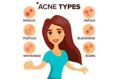 Acne Types Vector. Girl With Acne. Skin Care. Treatment, Healthy. Nodule, Whitehead. Isolated Flat Cartoon Character Illustration