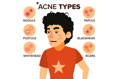 Acne Types Vector. Boy With Acne. Pimples, Wrinkles, Dry Skin, Blackheads. Isolated Flat Cartoon Character Illustration