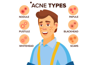 Acne Types Vector. Man With Acne. Facial Skin Problems. Papule, Pustulem Scards. Isolated Flat Cartoon Character Illustration