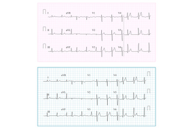 Heart Cardiogram Chart Vector. Set Healthy Heart Rhythm, Ischemia, Infarction. Vitality Heartbeat, Heart Electrocardiogram, Pulse Line