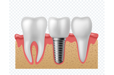 Tooth implant. Human teeth and dental implant&2C; denture orthodontic tec