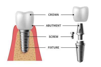 Tooth implant. Realistic implant structure pictorial models crown. Abu