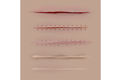 Surgical sutures healing stages. Realistic bloody wound and stitch. Sc