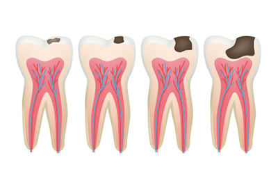 Caries tooth. Decay pulpit dental problem procedure root vector tooth