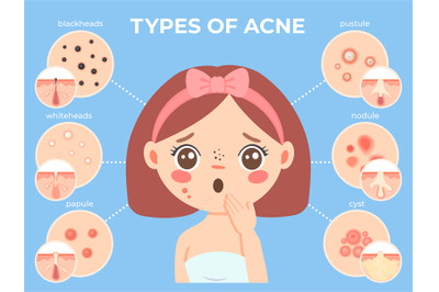 Girl with acne. Young unhappy female face with skin problems and pimpl