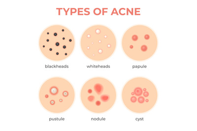 Acne types. Skin infection problem&2C; pimples grade and type cyst&2C; white