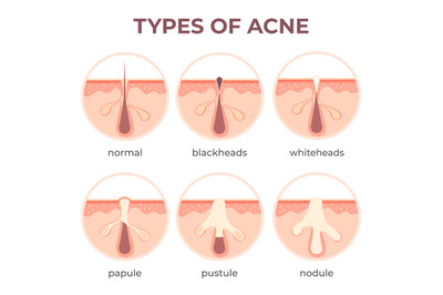 Acne types anatomy. Pimple diseases sectional view blackhead, cystic a