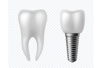 Teeth and implant. Dental surgery human white enamel tooth crown dentu