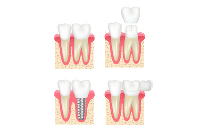 Dental crown. Tooth veneer implants healthy cavity stomatology dentist