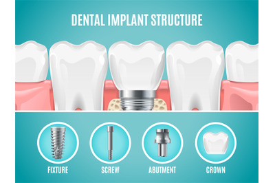 Dental implant structure. Vector reallistic tooth implant cut. Dental