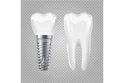 Dental implant. Realistic healthy tooth and implant. Vector dental sur