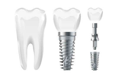 Dental surgery. Implant cut and healthy tooth. Realistic vector dental