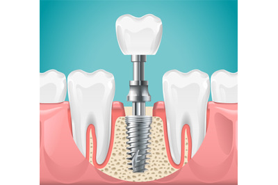 Dental surgery. Tooth implant cut vector illustration. Healthy teeth a