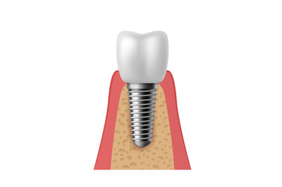 Realistic tooth implant. 3D denture orthodontic implantation teeth, im