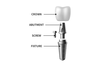 Tooth implant. Realistic dental implant structure, pictorial models cr