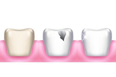 Teeth problems. Tooth decay&2C; dental diseases&2C; infection caries and ena