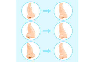 Cartoon rhinoplasty surgery. Rhinoplasty before and after, nose plasti