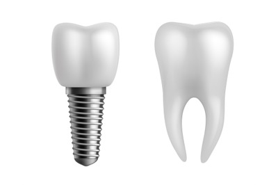 Dental implant and teeth. Realistic orthodontic elements. Human white