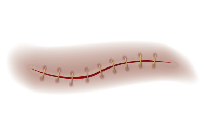 Scar or wound. Realistic bloody stitch. Surgical sutures healing seam